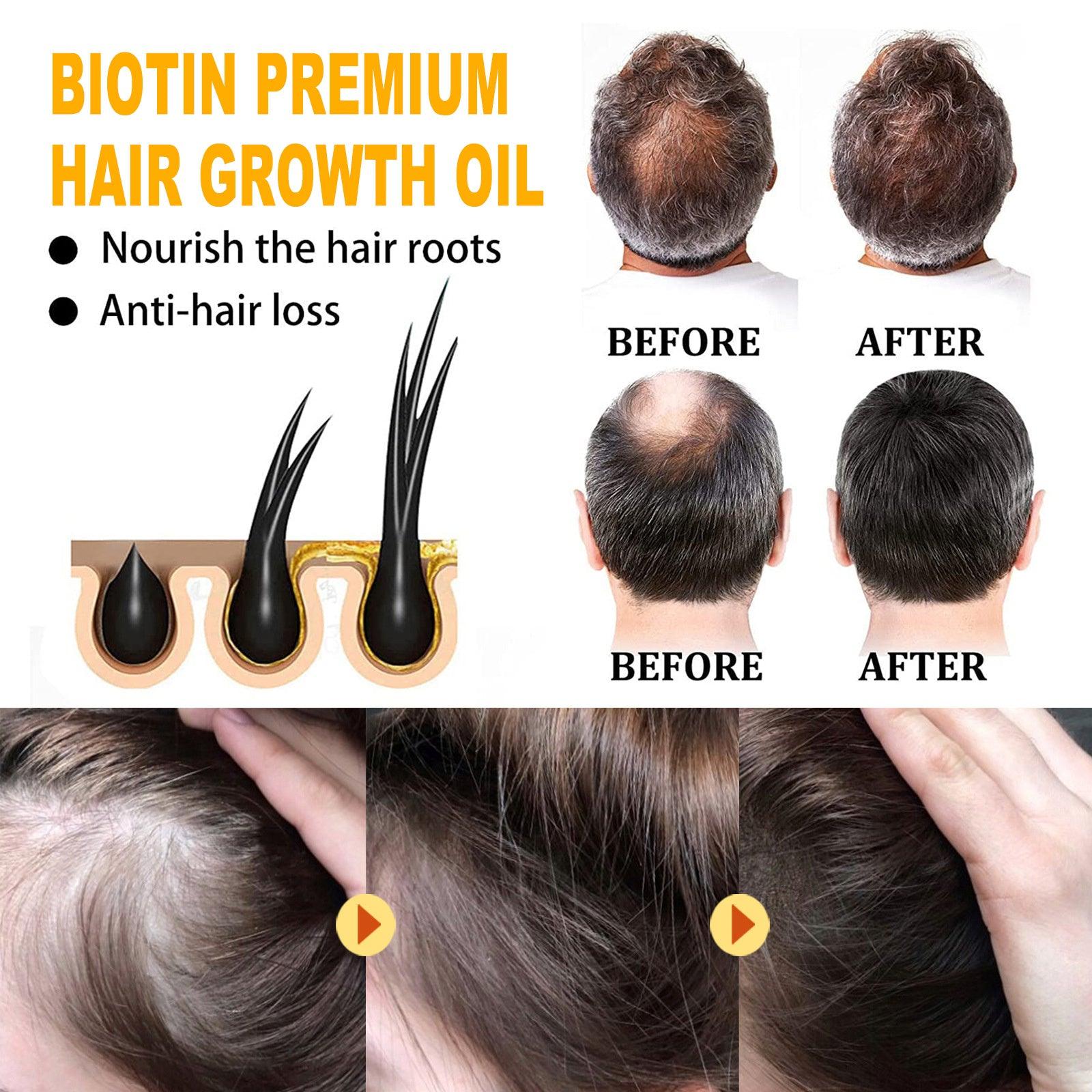 EELHOE Biotin Hair Treatment Oil Deeply Moisturizing Scalp Massage Treatment Thick And Smooth Hair Care Oil - Evallys.com # #