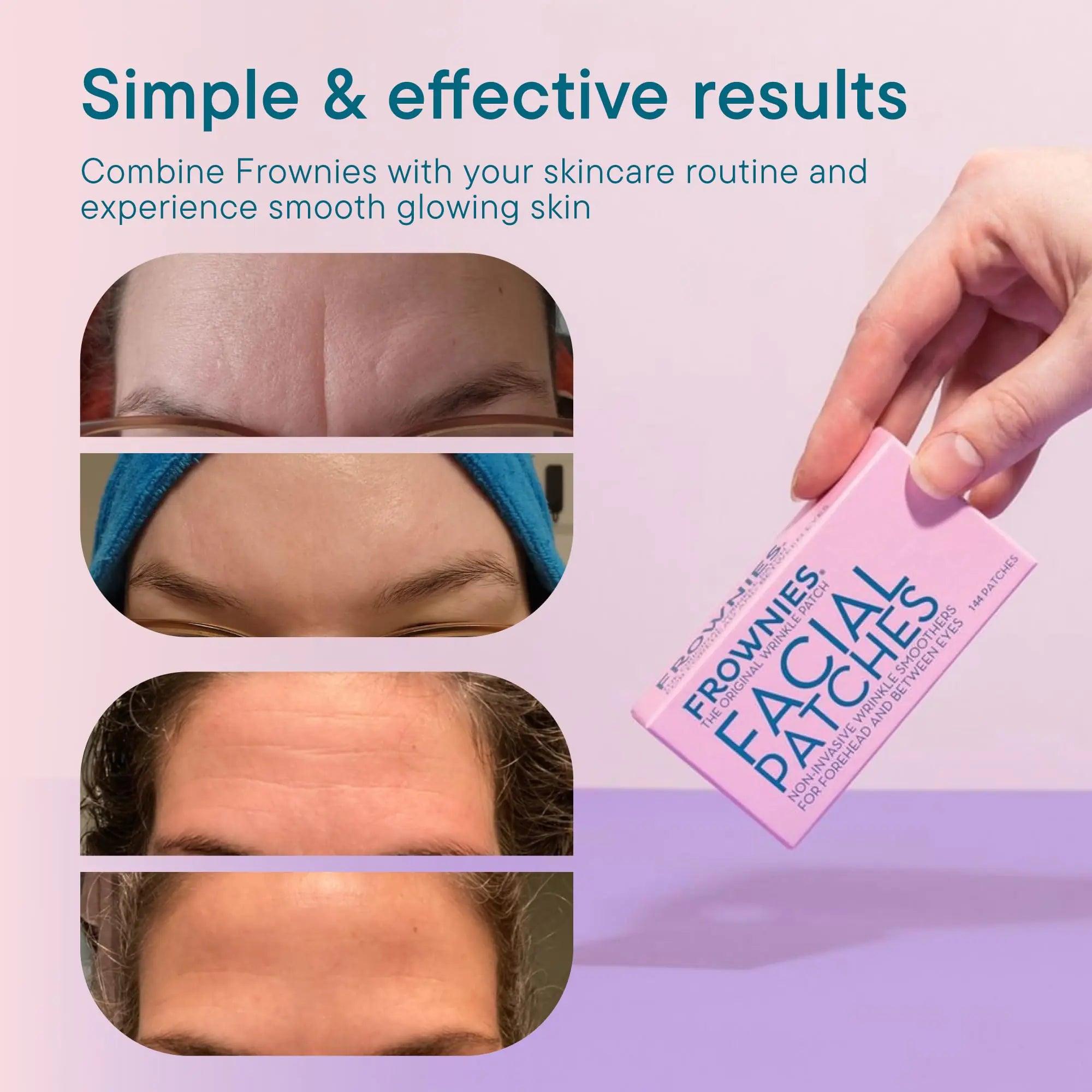 FROWNIES Forehead and Between the Eyes Wrinkle Patches - Hypoallergenic Facial Patches to Smooth & Soften Forehead Wrinkles & Eleven Lines - For Overnight Use, 144 Patches - Evallys.com # #