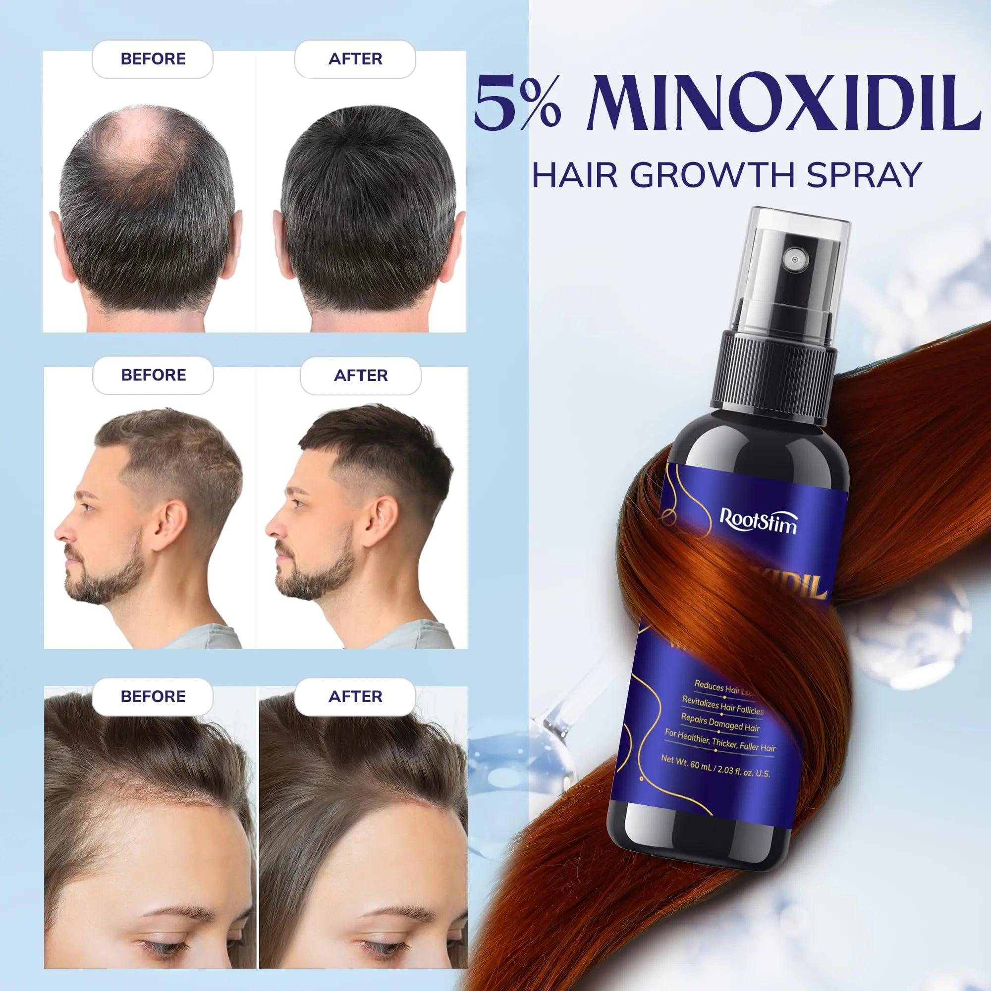 5% Minoxidil Hair Growth for Men and Women: Extra Strength Minoxidil Hair Loss Treatment Serum with Rosemary for Faster Stronger Thicker Hair Growth 60ML 2.03 Fl Oz (Pack of 1) - Evallys.com # #