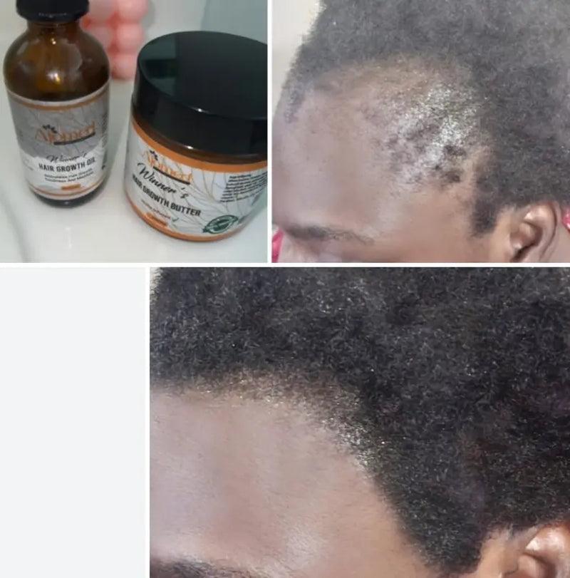 Rosemary and Fenugreek Hair Growth Butter Haircare Herbal, Hair Growth Balm, Alopecia Oil, Scalp Dandruff Moisturize - Evallys.com # #