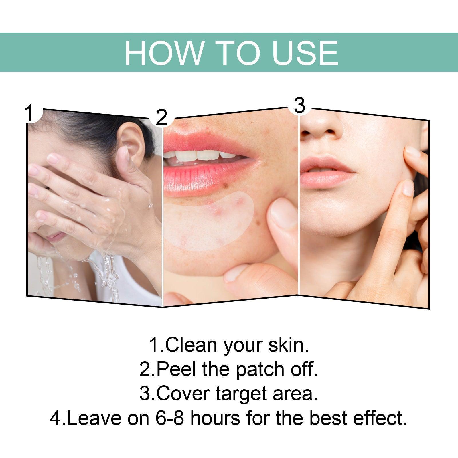 EELHOE Acne Relief Mask Patch Is A Gentle, Non-irritating Acne Mask That Helps To Reduce Acne Marks And Heal Acne. - Evallys.com # #