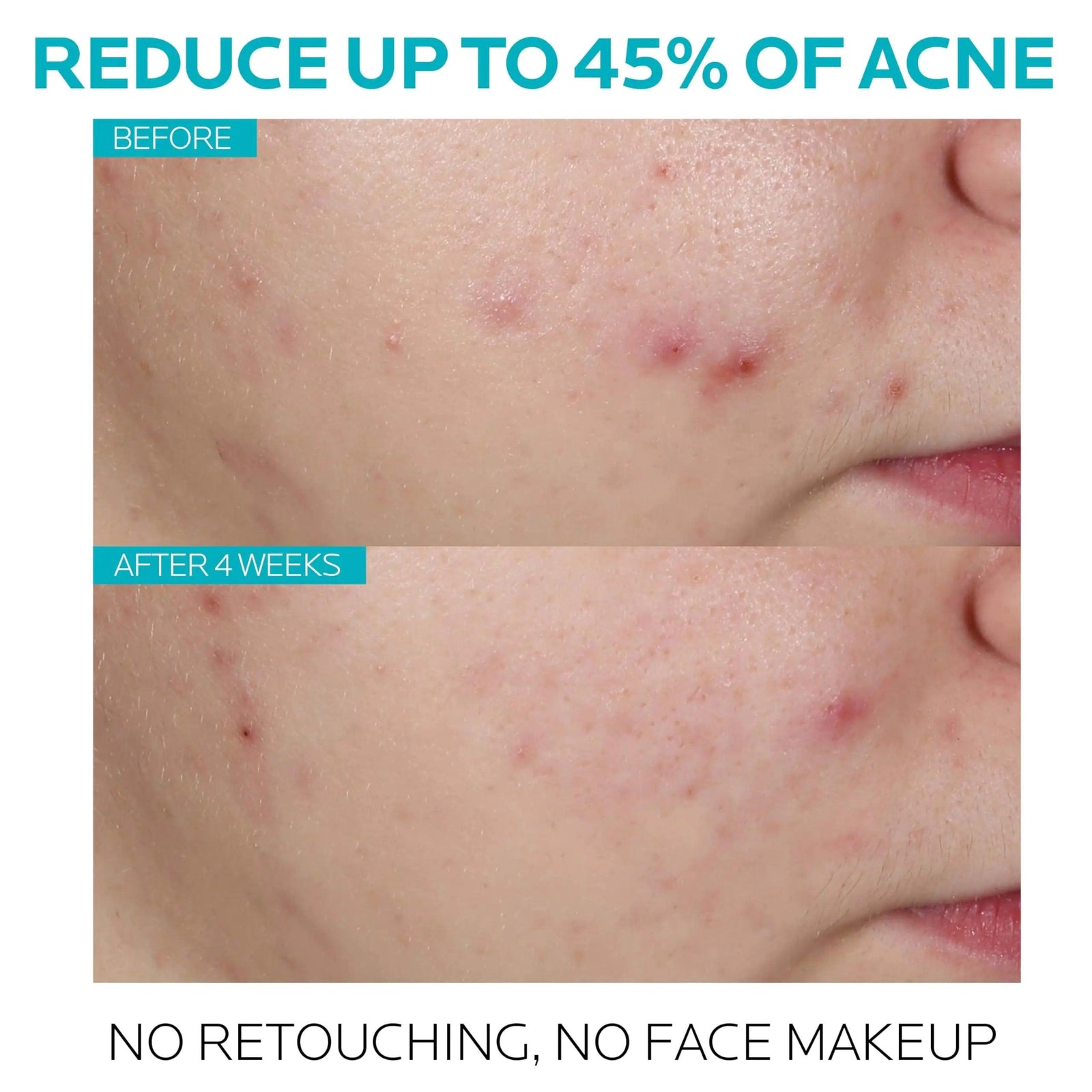 La Roche-Posay Effaclar Salicylic Acid Acne Treatment to Minimize Pores, Clear Acne Blemishes and Post Acne Marks - Evallys.com # #