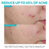 La Roche-Posay Effaclar Salicylic Acid Acne Treatment to Minimize Pores, Clear Acne Blemishes and Post Acne Marks - Evallys.com # #