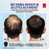 Taro Minoxidil Topical Aerosol Foam, 5%, Hair Regrowth Treatment for Men, 2.11 oz 2.11 Ounce (Pack of 1) - Evallys.com # #