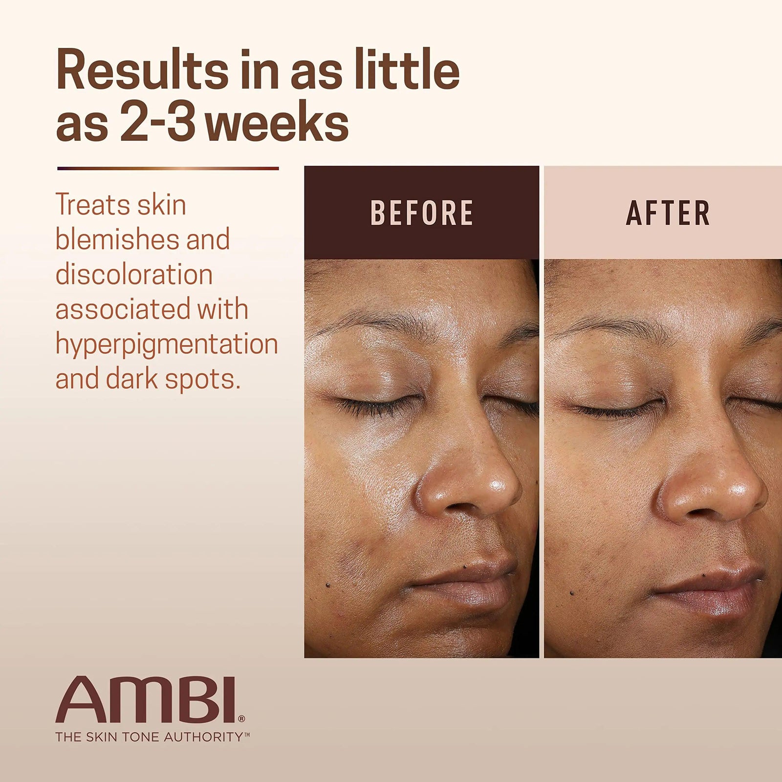 Ambi Even & Clear Advanced Fade Cream, Hydroquinone-free, Hyperpigmentation Treatment, Stubborn Dark Spot Corrector, Results In As Little As 2-3 Weeks, Niacinamide, Licorice Root Extract, PHA, 1 Fl Oz 5% Niacinamide & Licorice Root Extract - Evallys.com # #