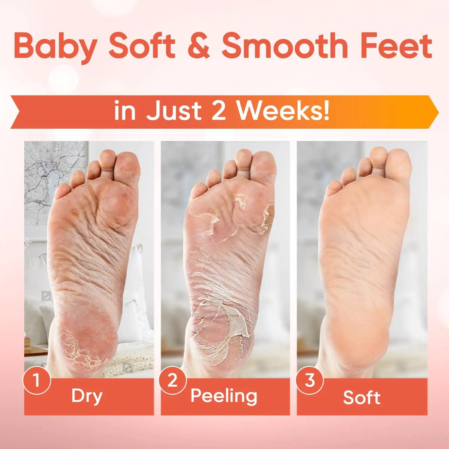 Foot Peel Mask (5 Pairs) - Foot Mask for Baby Soft Skin - Remove Dead Skin, Dry, Cracked Feet & Callus, Foot Spa, Made with Aloe Vera Extract for Women and Men Feet Peeling Mask Exfoliating, Peach 5 Pair (Pack of 1) - Evallys.com # #